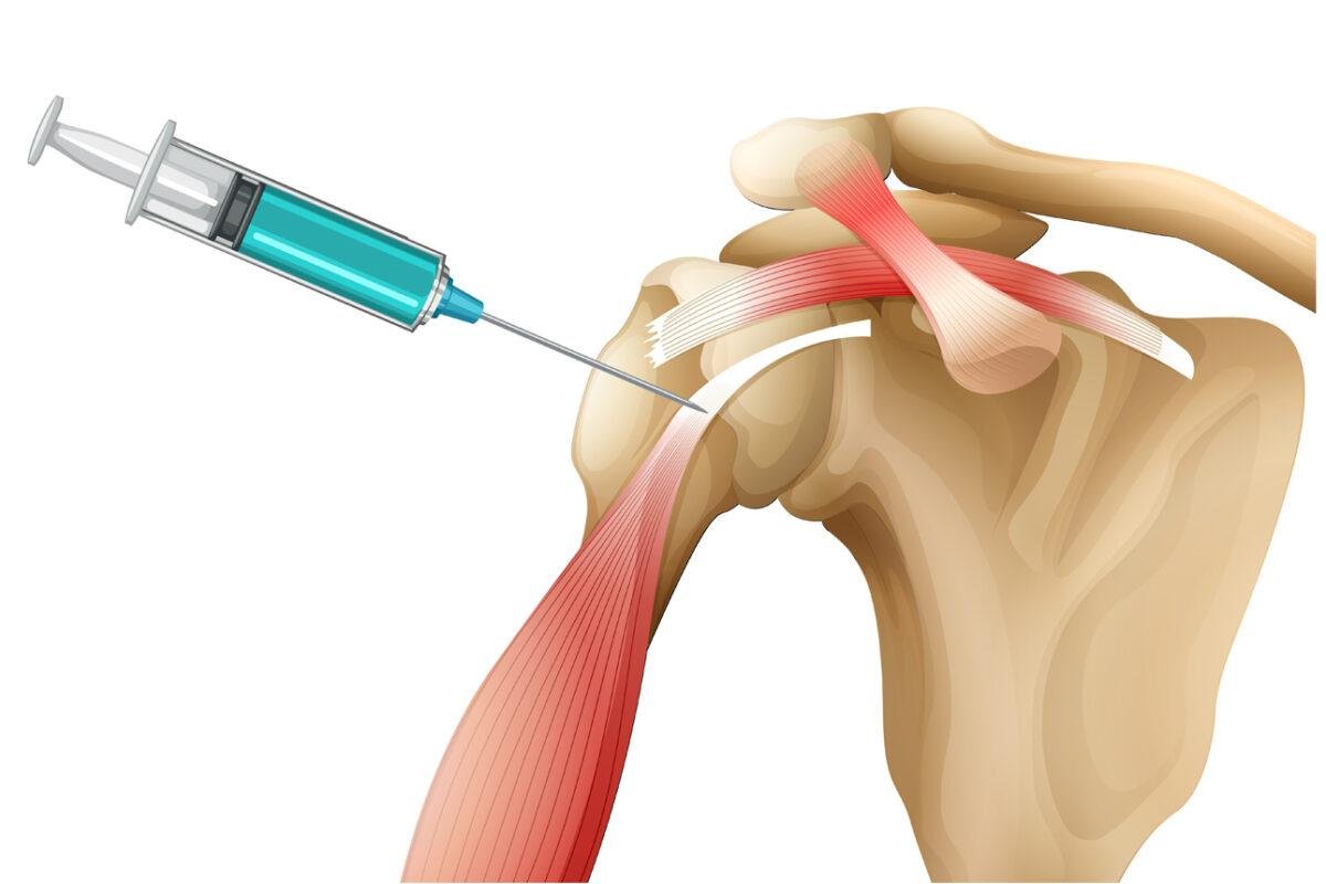 types-of-injections-for-knee-pain-goodrx