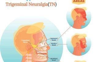 Trigeminal-Neuralgia- Treatment-in-Pune