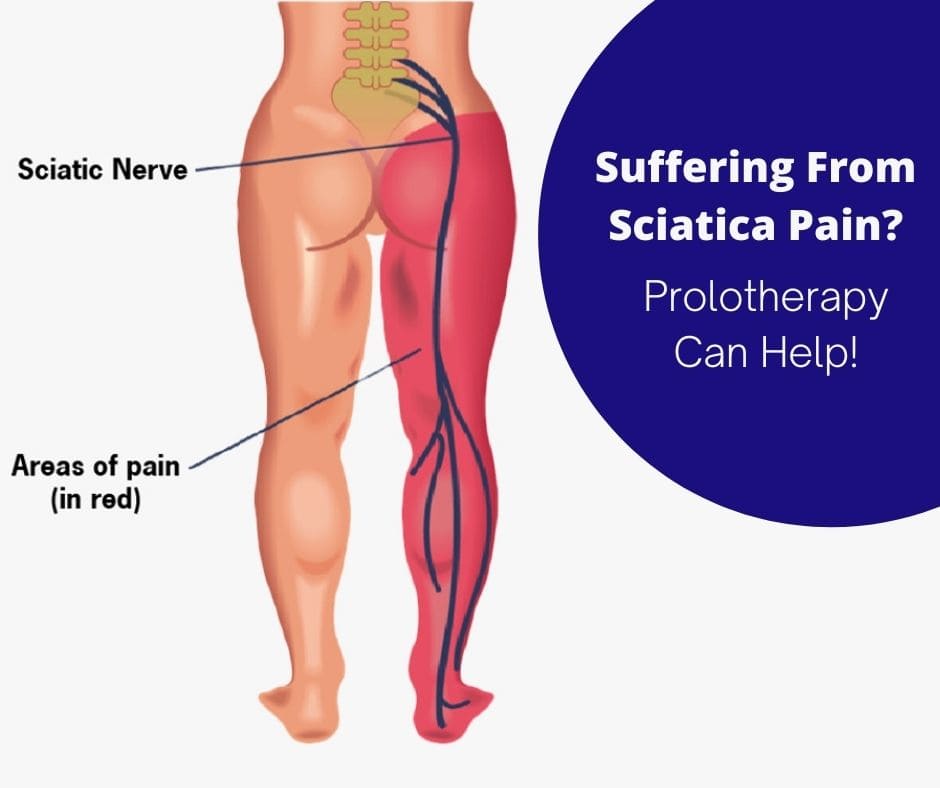 What is Sciatica and how do you treat Sciatic nerve pain?