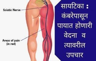 Scatica-pain-treatment-in-pune