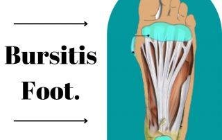 bursitis-foot