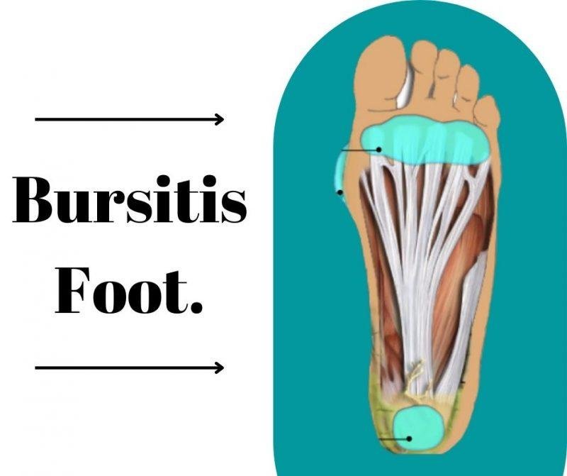 bursitis-foot-doctor-in-pune-the-prolotherapy-clinic