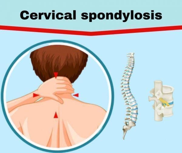 What Is Cervical Spondylosis | The Prolotherapy Clinic