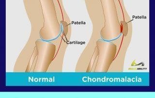 Chondromalacia- patellae-Treatment-in -Pune