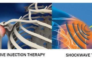 RIT-and-shockwave-therapy-for-frozen-shoulder