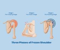 The Three Phases Of Frozen Shoulder 