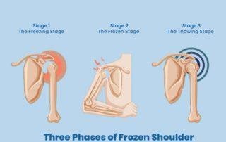 three-phases-of-frozen-shoulder