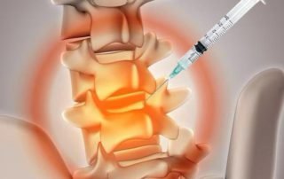 Injection-for-lower-back-pain