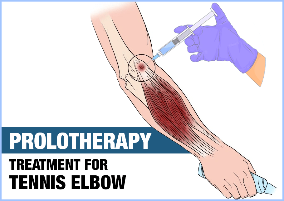 Prolotherapy-treatment-fro-tennis-elbow