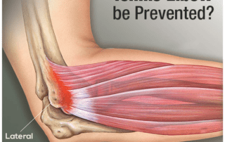 How-can-tennis-elbow-be-prevented