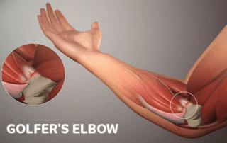 golfer's-elbow-treatment-in-pune