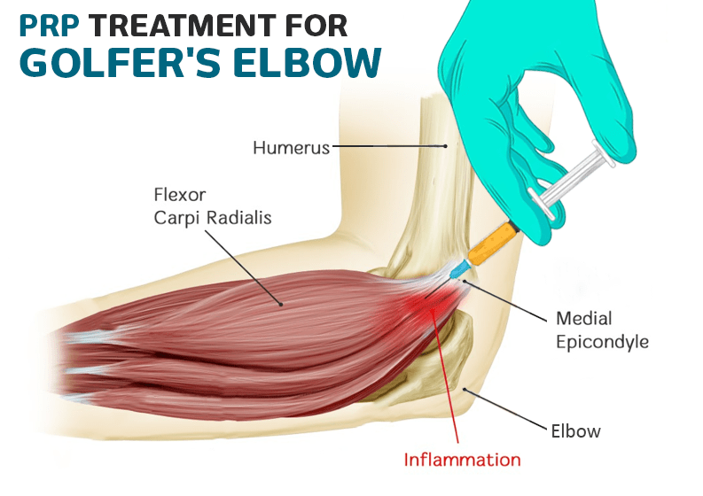 prp-treatment-for-golfer's-elbow