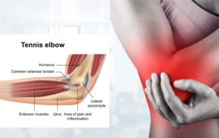 Rotator cuff tear